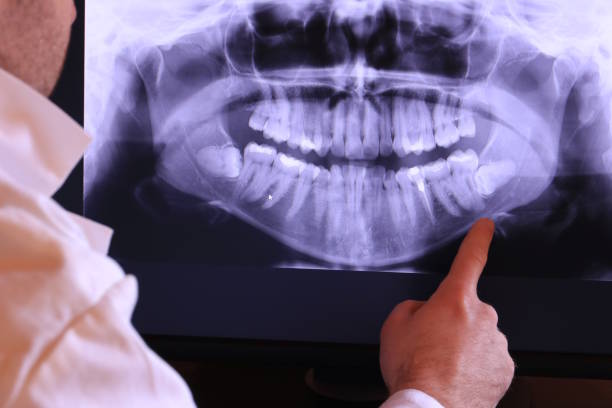 Best Emergency Wisdom Teeth Removal in Bannockburn, IL
