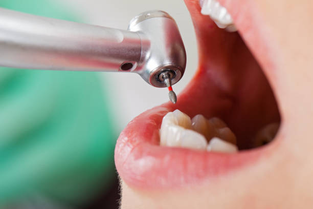 Best Emergency Wisdom Teeth Removal in Bannockburn, IL
